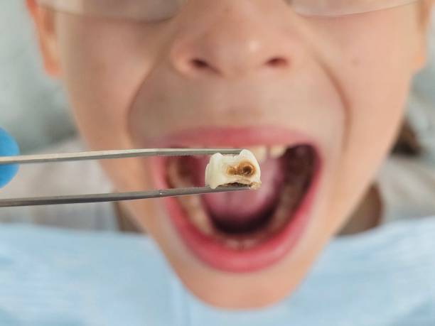 Best Emergency Dental Extractions in The Hills, NJ