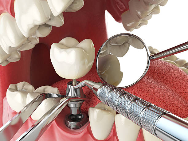 Best Emergency Dentist for Lost Fillings or Crowns in The Hills, NJ